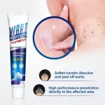 Wart Remover Ointment | Natural Treatment for Warts, Corns & Calluses