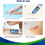 Wart Remover Ointment | Natural Treatment for Warts, Corns & Calluses